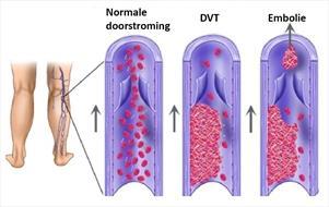 Chronisch: CVI, PTS (na DVT), varices, ulcus cruris venosum