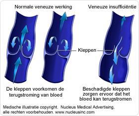 Veneuze insufficiëntie Tekortschieten van het diepe en oppervlakkige veneuze systeem op micro- en macroniveau Door: m.n. klepschade, reflux, obstructie, stenose, veneuze hypertensie Daardoor