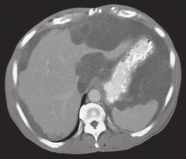 Op deze wijze kan de karakteristieke verdeling van pseudomyxoma peritonei worden verklaard, met minimale tumorgroei in de appendixregio en vaak veel tumor ter plaatse van de ovaria, het omentum en