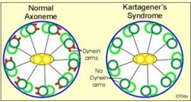 Kartagener syndroom/ PCD Primaire ciliaire dyskinesie (PCD) wordt