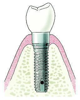 Implantaten als houvast voor kunstgebit in de bovenkaak Inleiding Binnenkort ondergaat u een operatie in de bovenkaak voor het aanbrengen van implantaten om het houvast van uw kunstgebit te