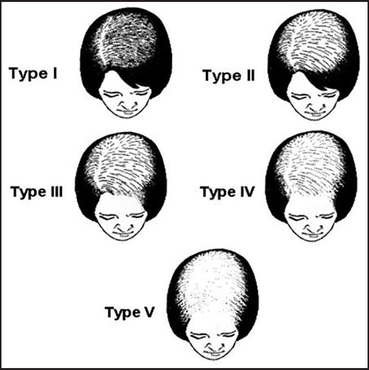 female-pattern hair loss
