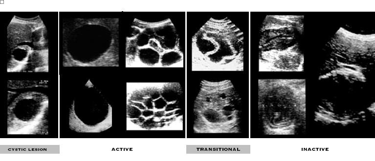 Classification of ultrasound Echinococcus cysts: http://www.