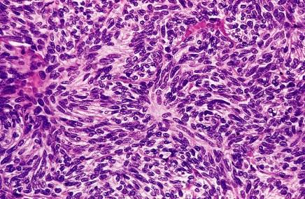 Pathologische WHO classificatie Type A thymoma (spindle cell, medullary)