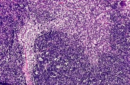 Pathologische WHO classificatie Type AB thymoma (mixed) A mixture