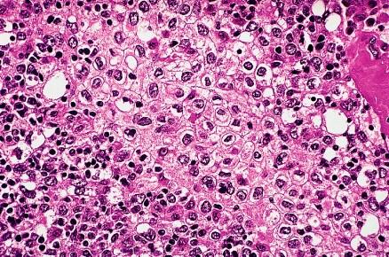 Pathologische WHO classificatie Type B3 (epithelial, well differentiated thymic carcinoma)