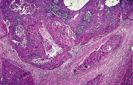 WHO classification Type C (thymic carcinoma)