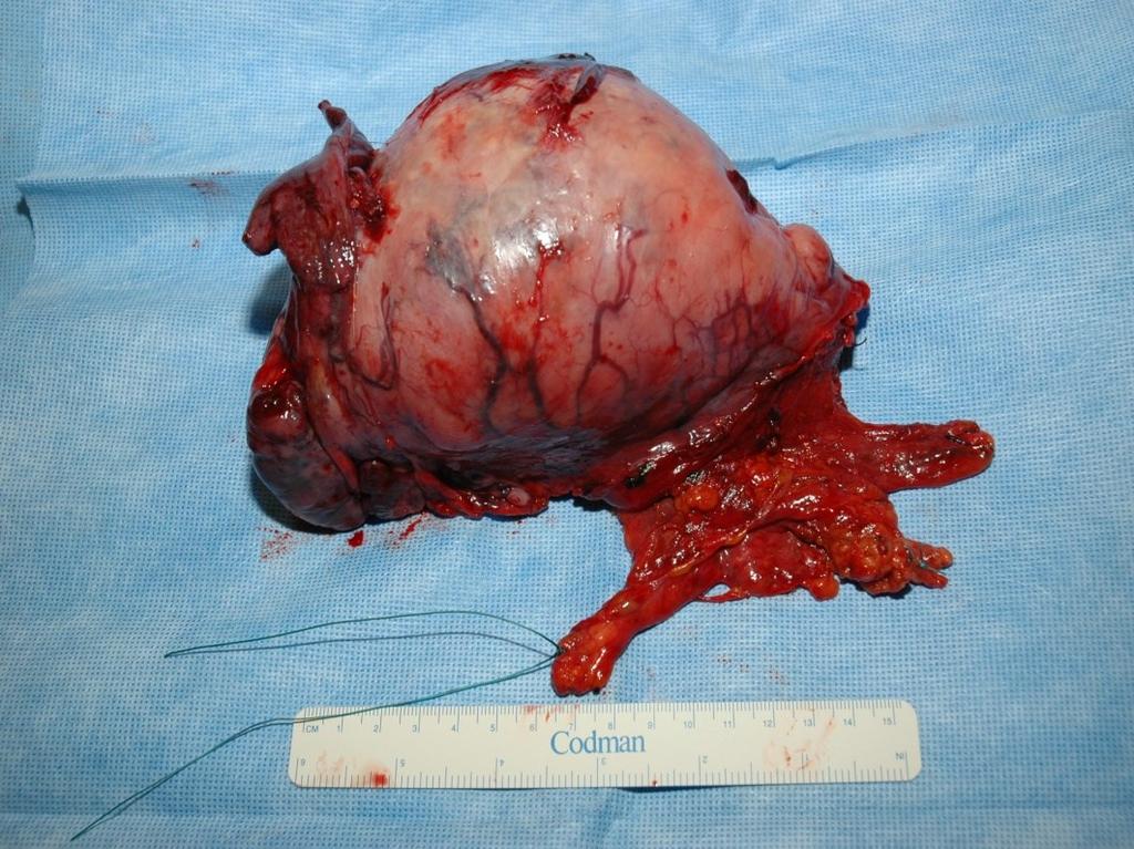 Patient pathologie: cortical thymoom; WHO type