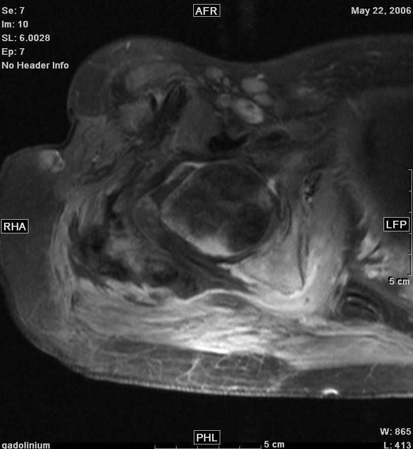 femur IV vancomycine July 2006: totale resectie Re heup