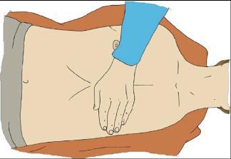 2.5 Compressie (Fig. 5) Compressie is de druk die jij als hulpverlener gaat uitoefenen op de borstkas van het slachtoffer. De compressie zal er bijgevolg voor zorgen dat er bloed wordt rondgestuwd.