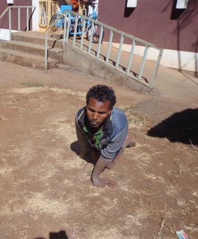 Atalay (15) heeft sinds zijn 6 e jaar verlamde benen. Waarschijnlijk als gevolg van polio. Hij komt uit een zeer arme familie.
