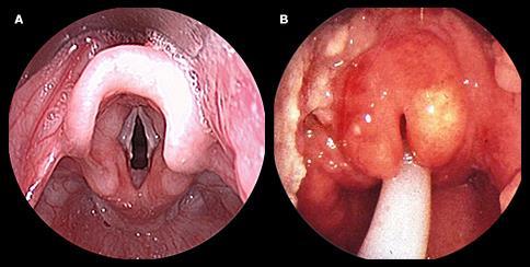 Laryngitis stridulosa Differentiaaldiagnose (stridor): Epiglottitis (H.