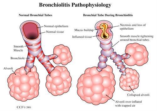 Bronchiolitis Acute lage luchtweginfectie thv terminale en