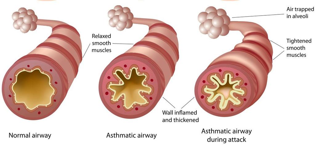Astma: wat