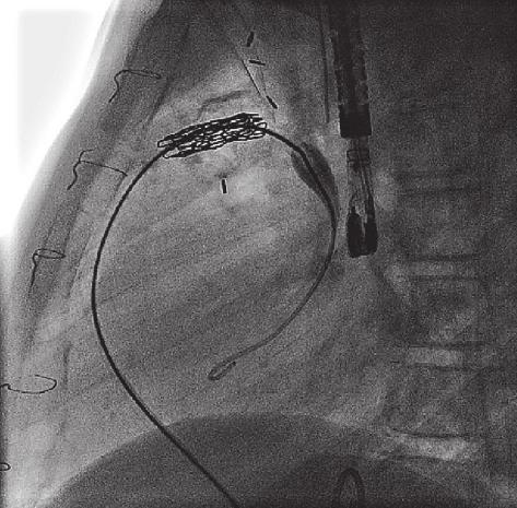 pulmonalis en de klepprothese c klepprothese ter plaatse van voormalige vernauwing katheter d figuur 1.