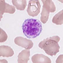 reuzentrombocyten (afbeeldingen 21 en 135) Zeldzame onrijpe granulocyten (afbeeldingen 52, 145 en 157) Zowel de bloedtelling (bicytopenie) als de klinische gegevens (onverklaarbaar gewichtsverlies,