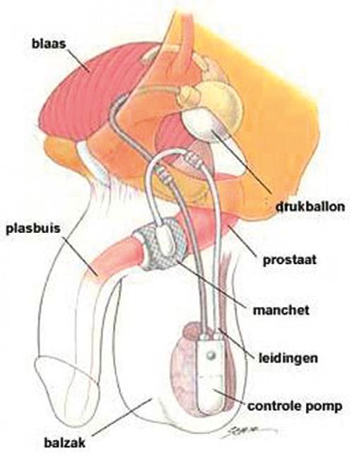 FIGUUR 1 Schematische weergave van de artificiële urologische sfincterprothese (AMS-800), in situ bij een man. Een manchet sluit de urethra af, waardoor urine niet uit de blaas kan lopen.