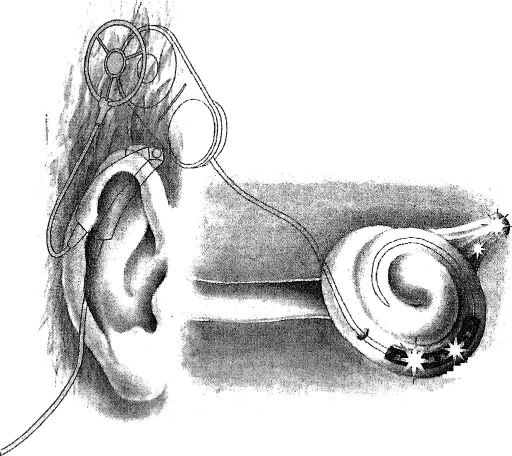 AUDITIEVE WAARNEMING BU DOVE VOLWASSENEN 4 33 - Fig. i. Impressie van de uitwendige en inwendige delen van een cochleair implantatie systeem.