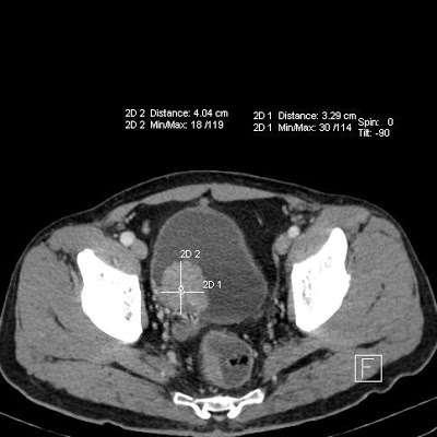 Diagnostiek Anamnese: Pijnloze macroscopische hematurie Onverklaarde