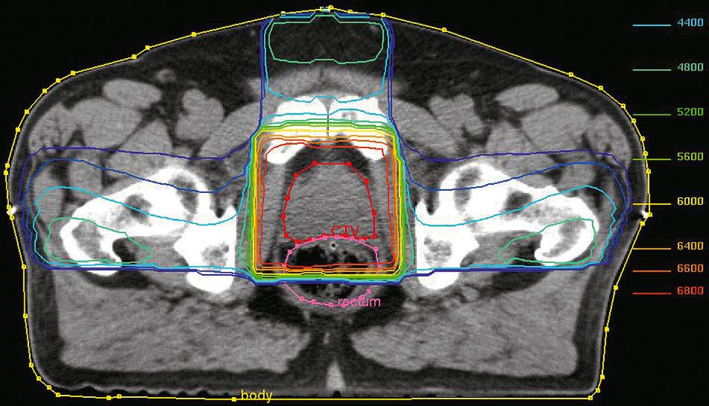 FIGUUR 2 Voorbeeld van een bestralingsplan: in de transversale CT-opname van het kleine bekken zijn de prostaattumor (rode lijn) en de gezonde weefsels (overige lijnen) getekend.