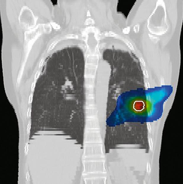 wegingen aangetoond door bij een aantal patiënten iedere dag een CT-scan te maken.