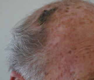 Maaike de Koff, Jacqueline Boot Een zeldzaam ulcus op het behaarde hoofd Casus Een 78-jarige man is door de reumatoloog verwezen naar de polikliniek dermatologie vanwege een huidafwijking op zijn