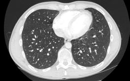 Door de hoeveelheid aan informatie van de beelden van aorta afwijkingen en de directie toegankelijkheid is CT het meest belangrijke onderzoek van de aorta voor