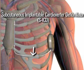 HARTCENTRUM ASZ EDITIE 2017 HC magazine In 2017 vond de eerste implantatie in het ASZ plaats van een leadless pacemaker.