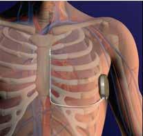 Deze innovatieve pacemaker kan geplaatst worden bij patiënten met een moeilijke veneuze toegang ter hoogte van de schouder zoals door de aanwezigheid van een port-a-cath.