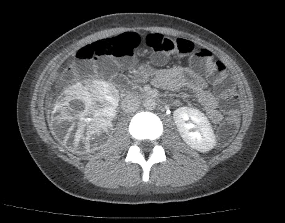 diffuus vergrote rechter nier met hypodense gebieden linker nier FIGUUR 2 CT-scan van het abdomen van patiënt B met een diffuus gezwollen rechter nier met hypodense gebieden.