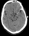 intracraniële bloeding