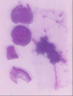 Scoringscriteria CK5 Aankleuringspatroon: cytoplasmatisch Normale slokdarm : matig tot sterke aankleuring van plaveiselcelepitheel doorheen alle cellagen (controle sensitiviteit) Prostaat hyperplasie