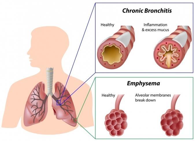 COPD: hoe