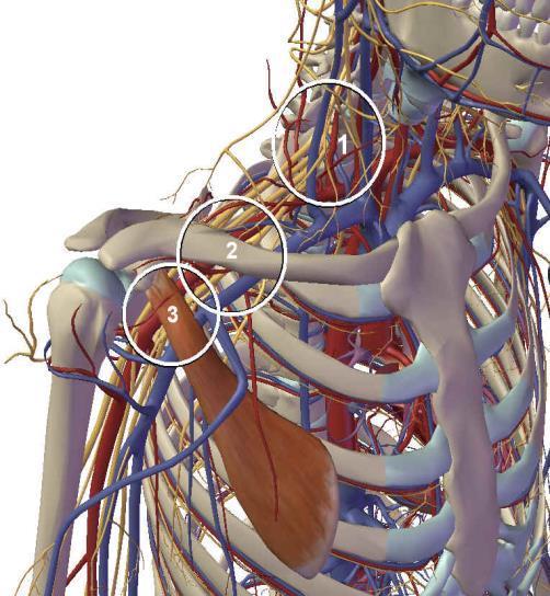 TOS algemeen TOS = symptomatische beknelling van de neurovasculaire bundel in de thoracic outlet Wat knelt er?