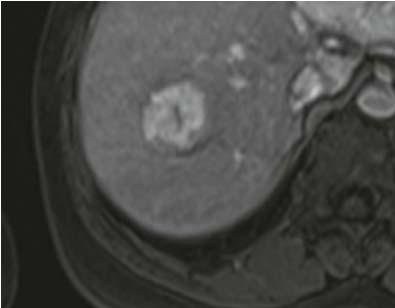 hepatocellulaire hyperplasie Prevalentie 1%, 9:1 vrouwen (30 40) MRI Vaak