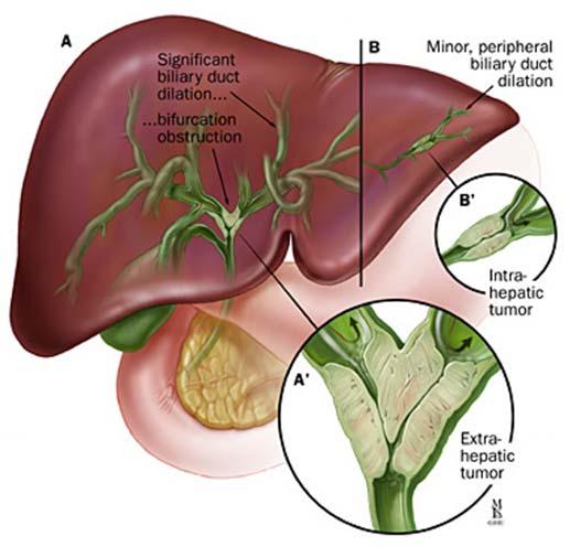 Cholangiocarcinoom Intrahepatisch Perihilair (Klatskin tumor) Subhilair Distaal Galwegobstructie! Extrahepatisch/hilair cholangiocarcinoom Epidemiologie: Incidentie 2/100.