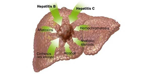 Maligne levertumoren 1. Van de levercellen zelf: hepatocellulair carcinoom (HCC) 2. Van de galwegen: intrahepatisch cholangiocarcinoom 3.