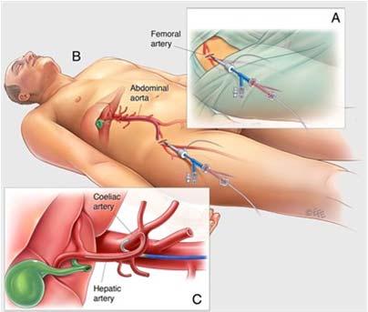 Nieuwe behandelingen Y90 radiation lobectomy (Y-embolisatie) Intra arteriele chemo (PUMP trial) Beoordeling MDO inclusief oncoloog en HPB chirurg Resectabel Initieel irresectabel Irresectabel