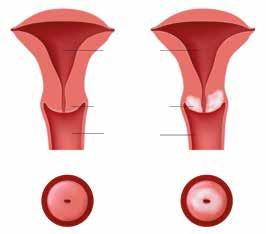 WAT IS BAARMOEDERHALSKANKER? Baarmoederhalskanker is een kwaadaardige aandoening van de baarmoederhals (cervix).