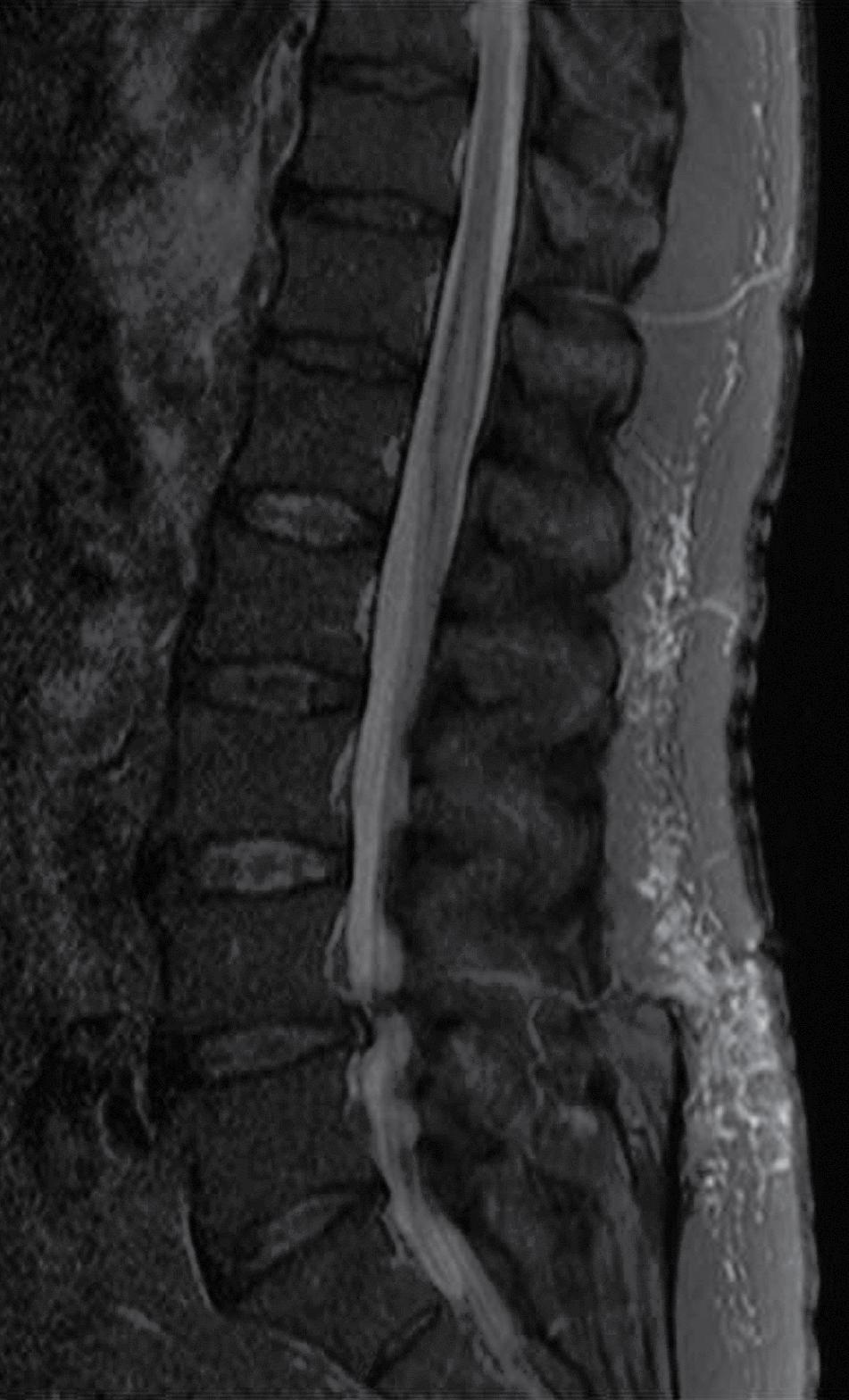 ruggenmerg TXII LI myelopathie met zwelling van het ruggenmerg FIGUUR 1 Sagittale T2 gewogen MRI-opname van patiënt A, met zwelling van het ruggenmerg en myelopathie ter hoogte van Txii en Li,