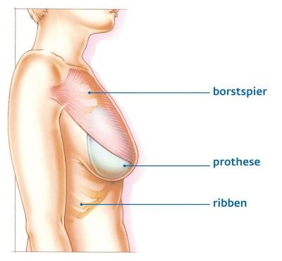 2/9 Inleiding Deze folder is bedoeld voor vrouwen die een borstamputatie (hebben) moeten ondergaan en reconstructie van de borst overwegen.