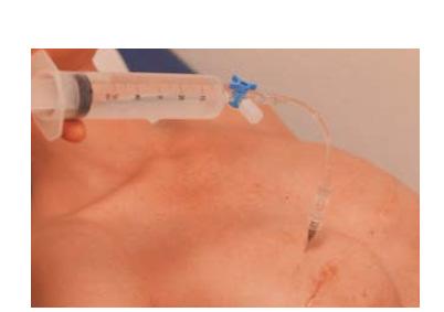 3/9 Borstreconstructie met een expander Bij deze methode wordt een prothese pas ingebracht nadat de huid en de borstspier eerst met een zogenoemd ballon- of tissue- expander zijn opgerekt.