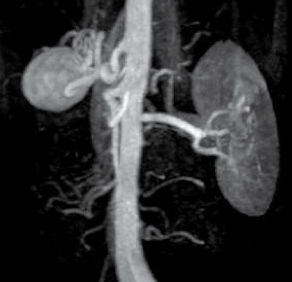 K L I N I S C H E P R A K T I J K aneurysma linker nier abdominale aorta rechter nier FIGUUR 1 CT-scan van patiënt A met een aneurysma van de A.