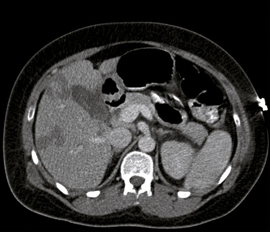 leverinfarcten galblaas V. cava inferior lever aorta linker nier milt FIGUUR CT-snede van het abdomen van patiënt A, met enkele ophelderingen in de lever die passen bij infarcering.