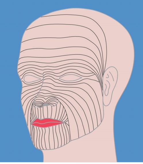 Afb. 2. Relaxed skin tension lines (RSTL): deze lijnen volgen de rimpels en plooien van gerelaxeerde huid in het aangezicht.
