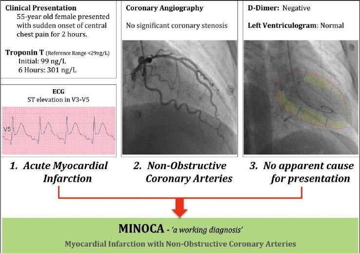Myocardial infarction with no-obstructive coronary
