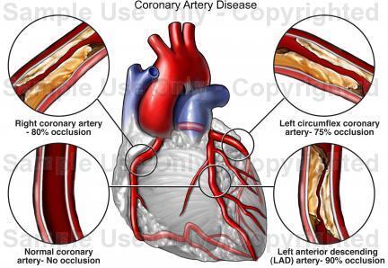 ischemie Angina