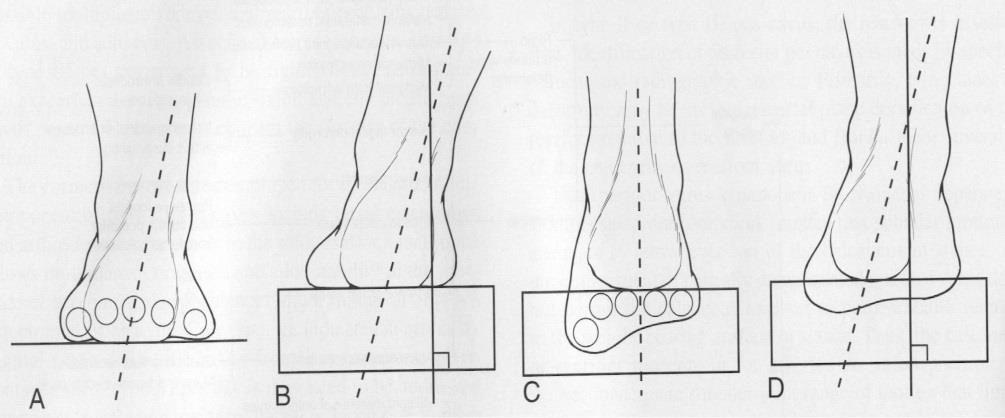rechts STG: neutraal links, pronatie rechts MTG: supinatie links, pronatie