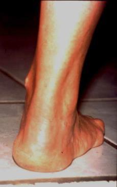 type voet