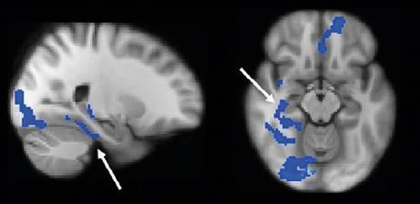 FUNCTIONELE REORGANISATIE Cognitive